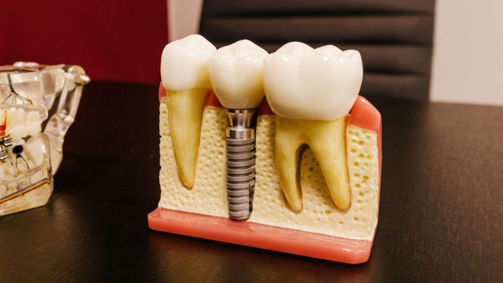 Permanent Dental Implants: Cost, Financing Options, and What to Expect Near You